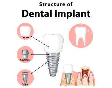 Dental Implants Charlottesville VA